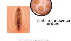 Dấu hiệu bệnh sùi mào gà ở nữ giới